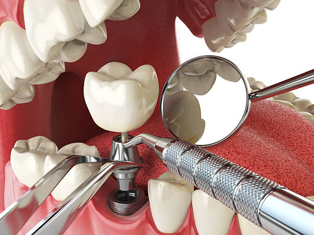Best Emergency Root Canal Treatment in Johnston, IA